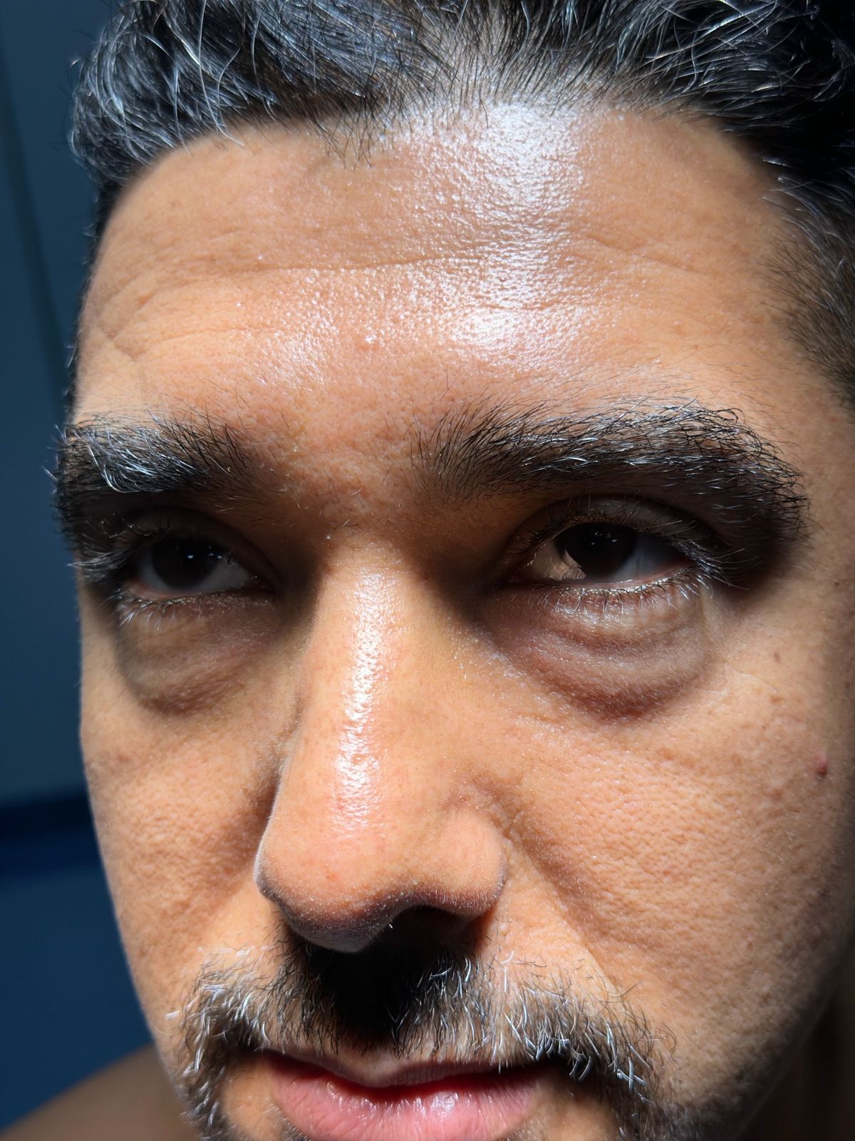 Avant — Blépharoplastie