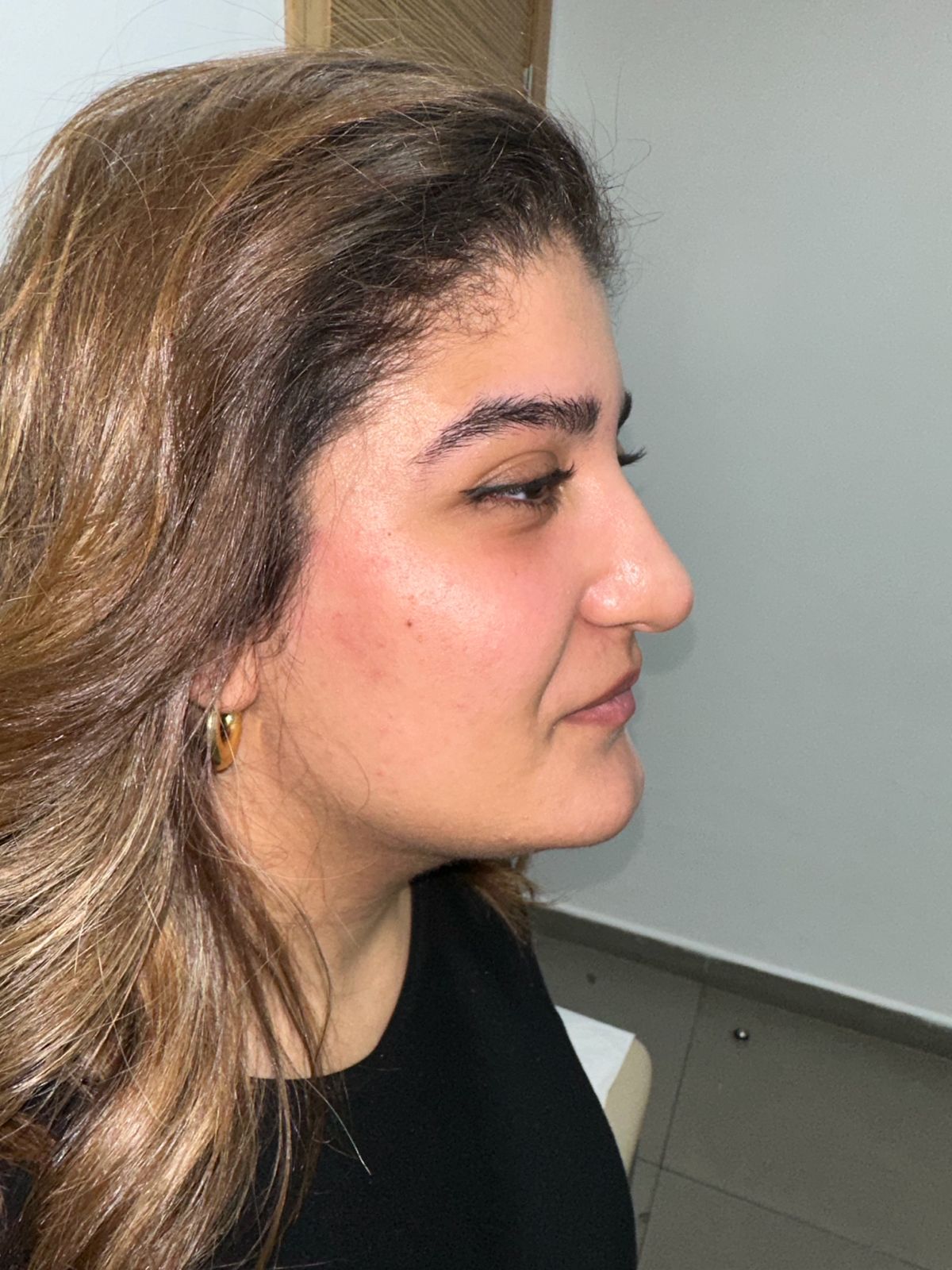 Après — Rhinoplastie — cas n°1
