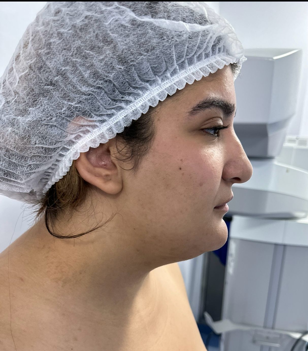 Avant — Rhinoplastie — cas n°1