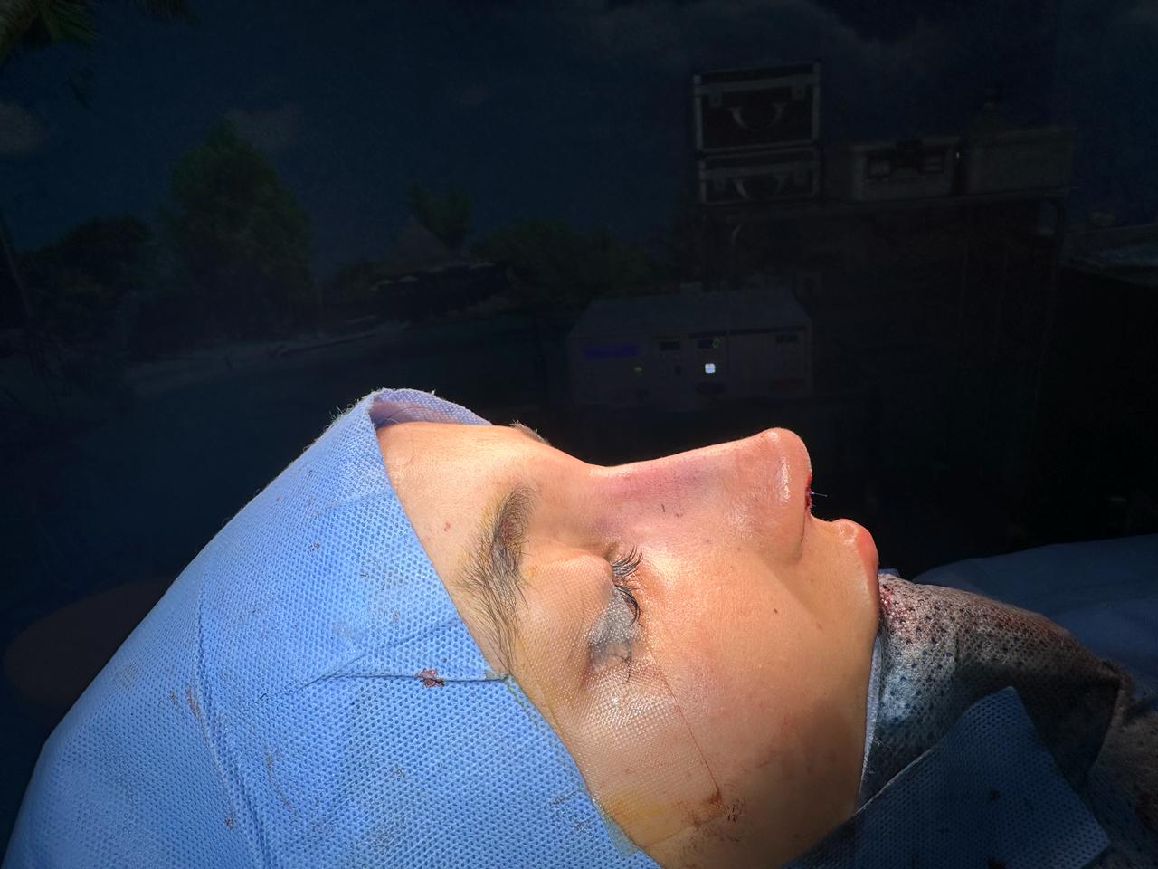 Après — Rhinoplastie — cas n°2