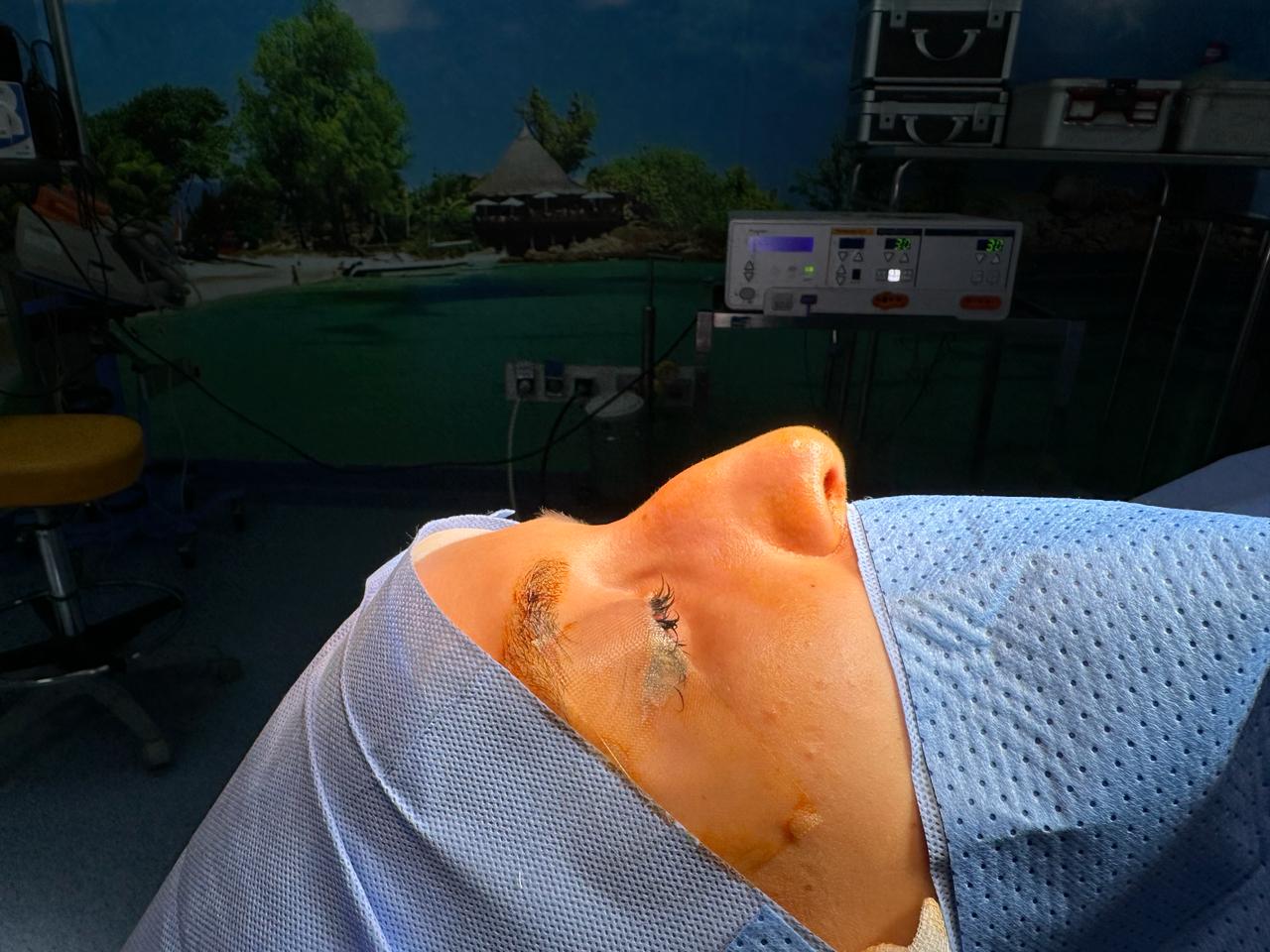 Avant — Rhinoplastie — cas n°2