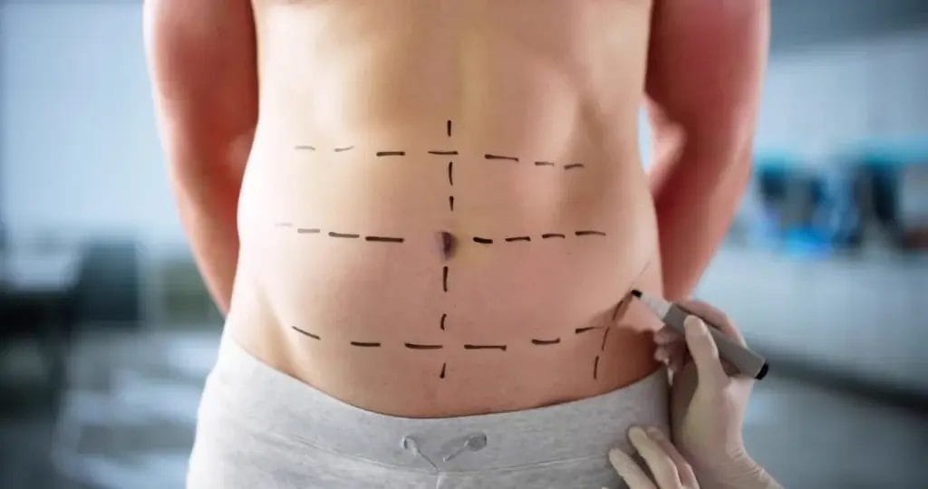 Chirurgie de la Silhouette