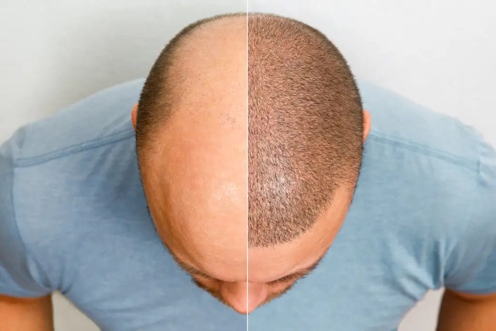 Greffe de Cheveux